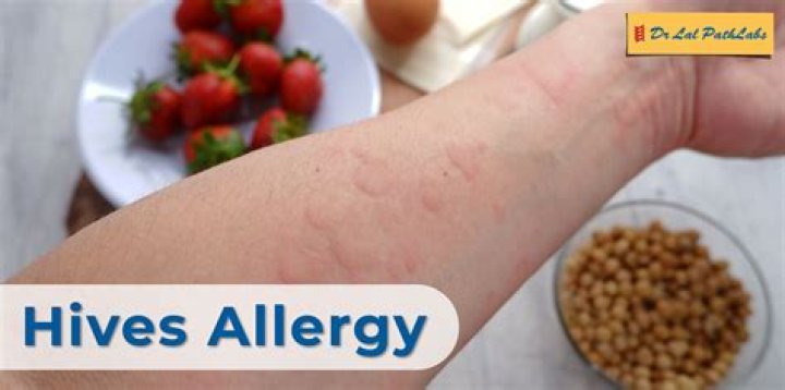 How long is too long to have hives?