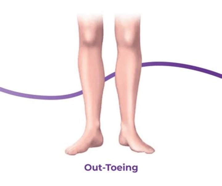 What can out toeing cause?